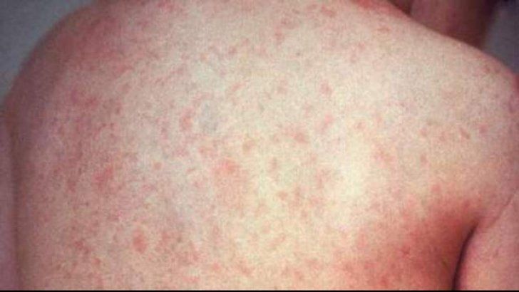 Suspiciune de scarlatină la o grădiniță din Slatina