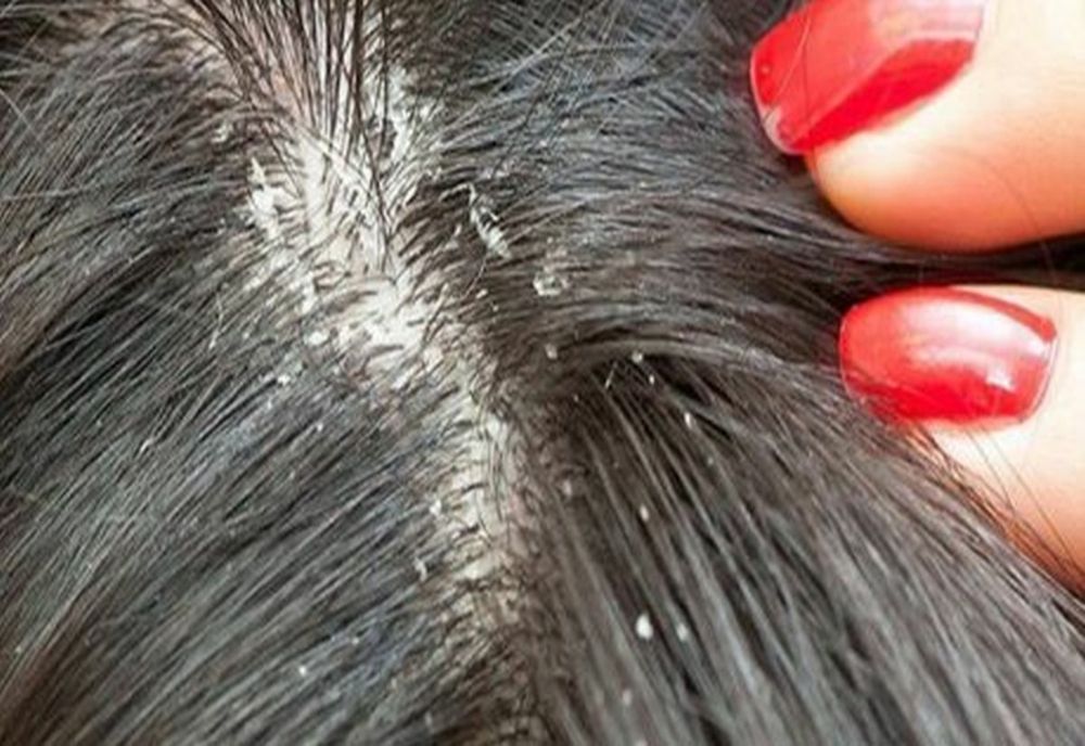 Olt: Zeci de elevi găsiţi cu păduchi