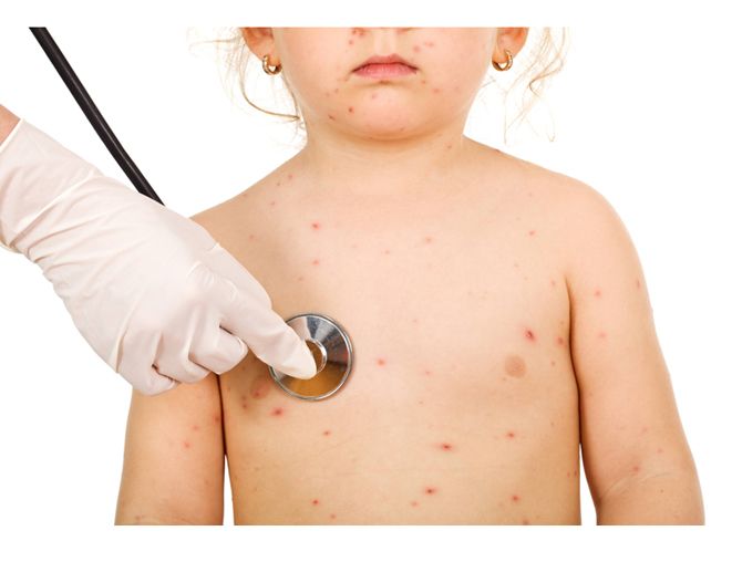 Little kid with small pox at the physical exam